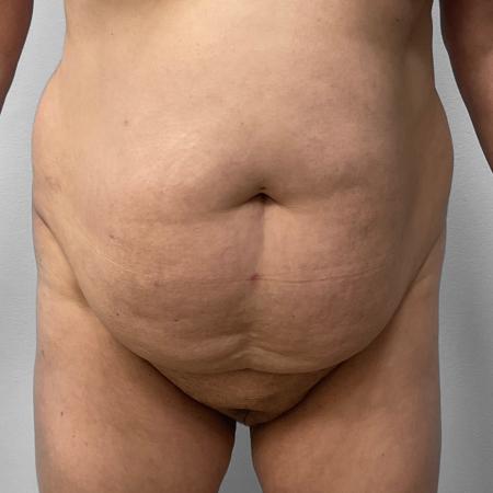 Tummy Tuck, Lipo, & BBL by Dr. Ali Qureshi — before and after