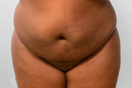 BBL Fat Transfer by Dr. Ali Qureshi — before and after