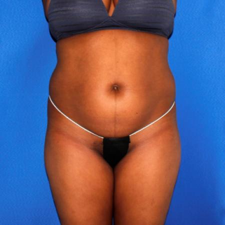 Liposuction and Fat Transfer to Buttock by Dr. Ali Qureshi — before