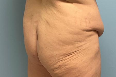 Butt Lift by Dr. Ali Qureshi — before and after