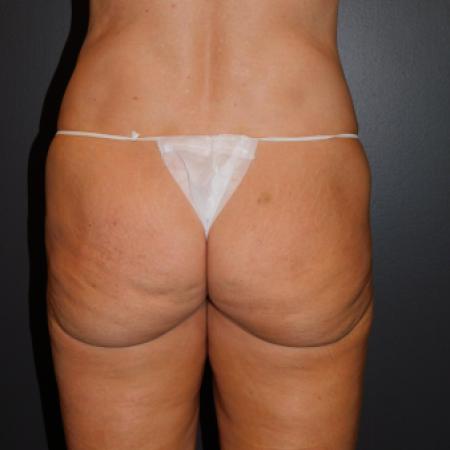 Buttock Lift by Dr. Ali Qureshi — before