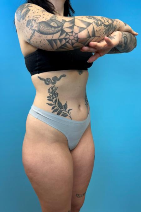 Skinny BBL by Dr. Ali Qureshi — before and after