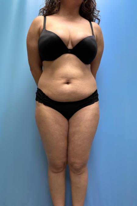 Tummy Tuck, Lipo, Brazilian Butt Lift, Renuvion by Dr. Ali Qureshi — before and after