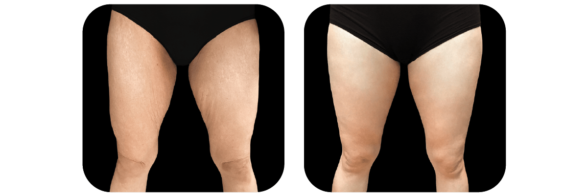 Thigh Lift before and after - after