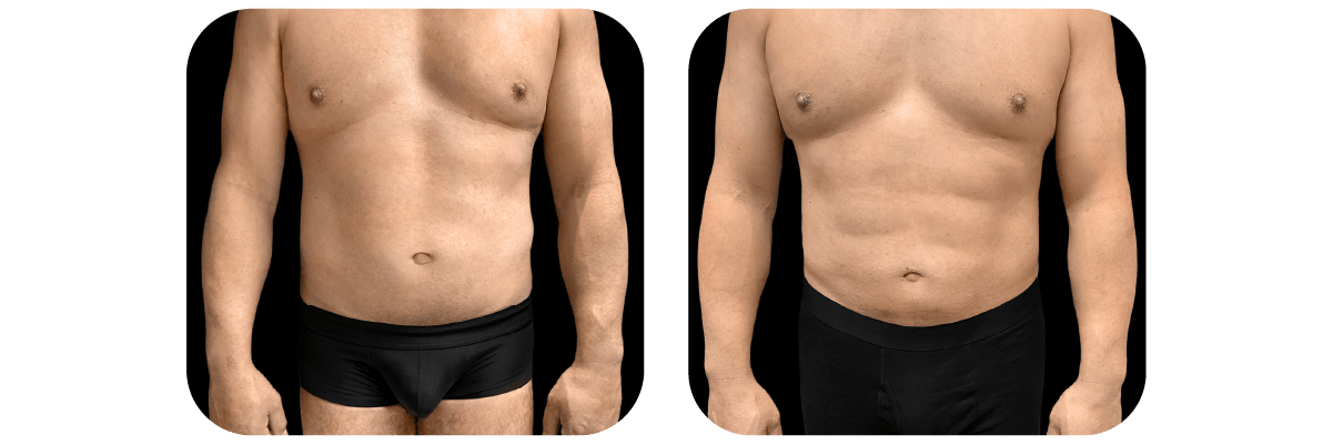 Abdominal etching before and after - after