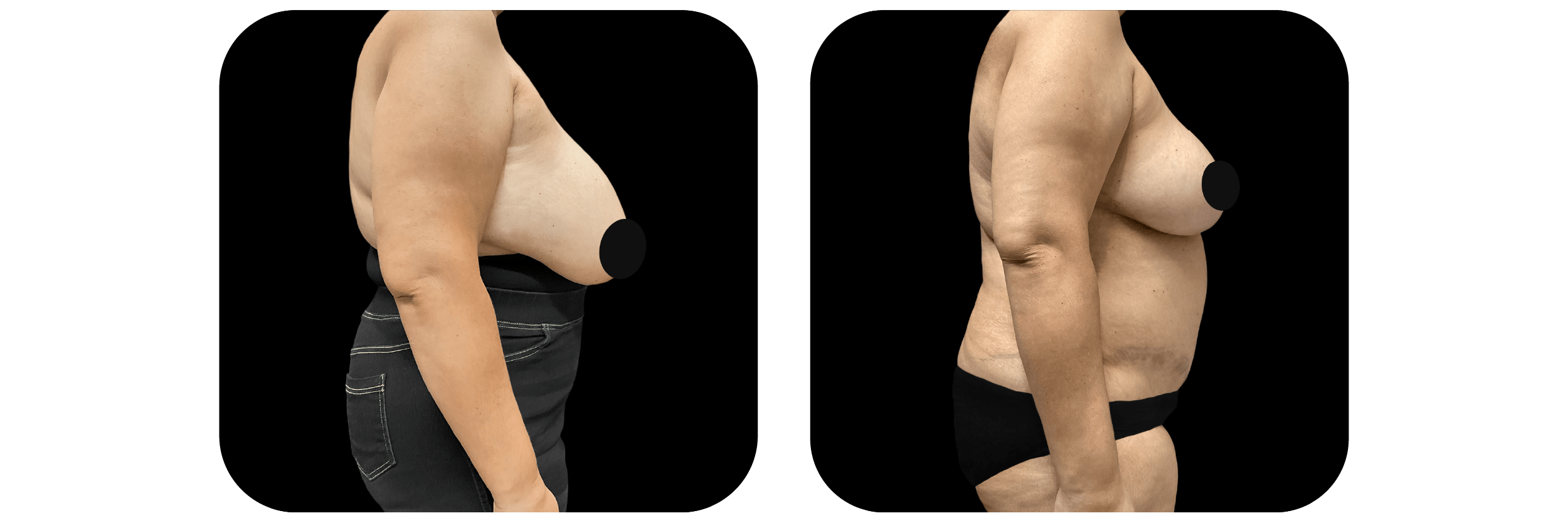Breast Reduction before and after - after