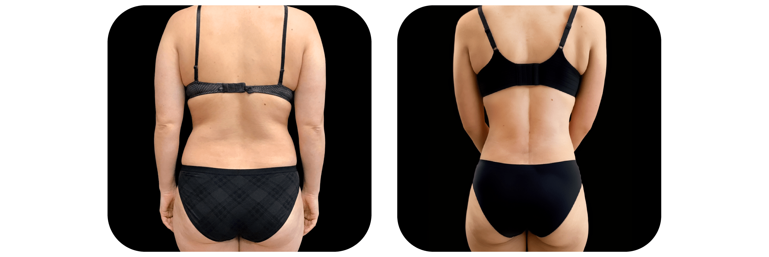 360 Liposuction before and after - after