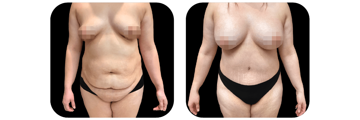 Mommy Makeover before and after - after