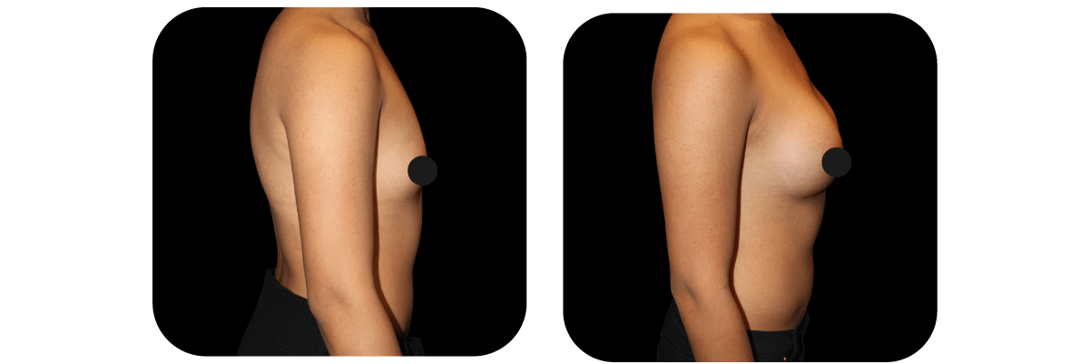 Gender Affirmation before and after - after