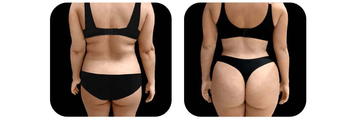 Brazilian Butt Lift / BBL before and after - after