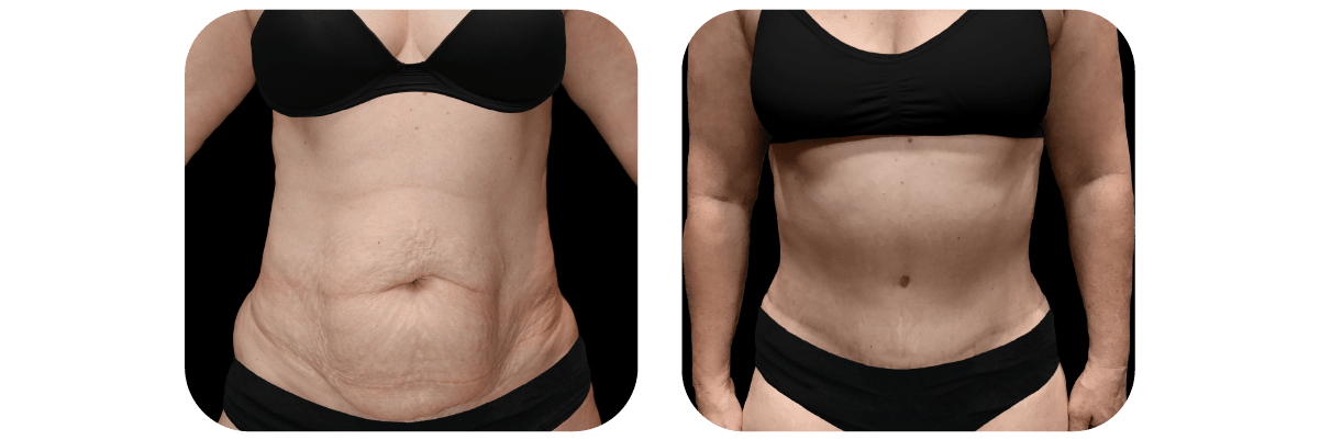 Tummy Tuck before and after - after