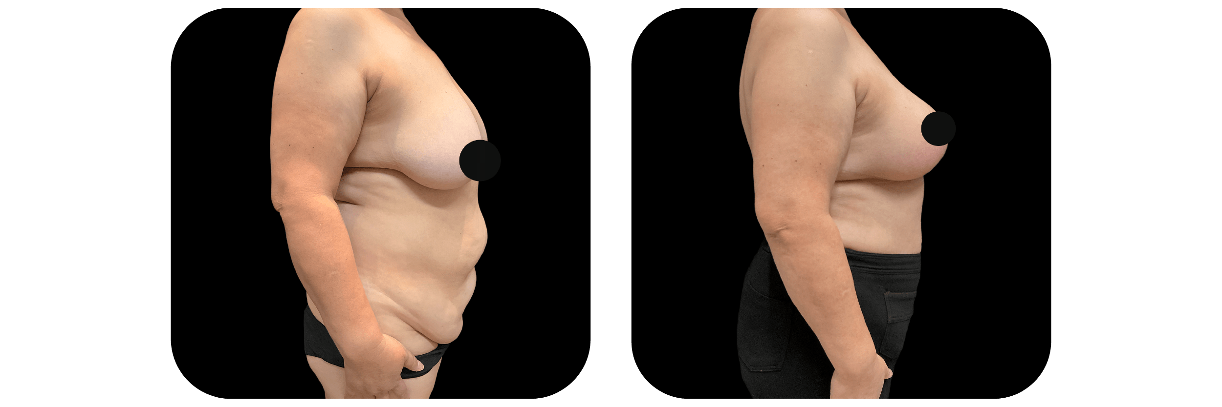 Breast Lift before and after - after