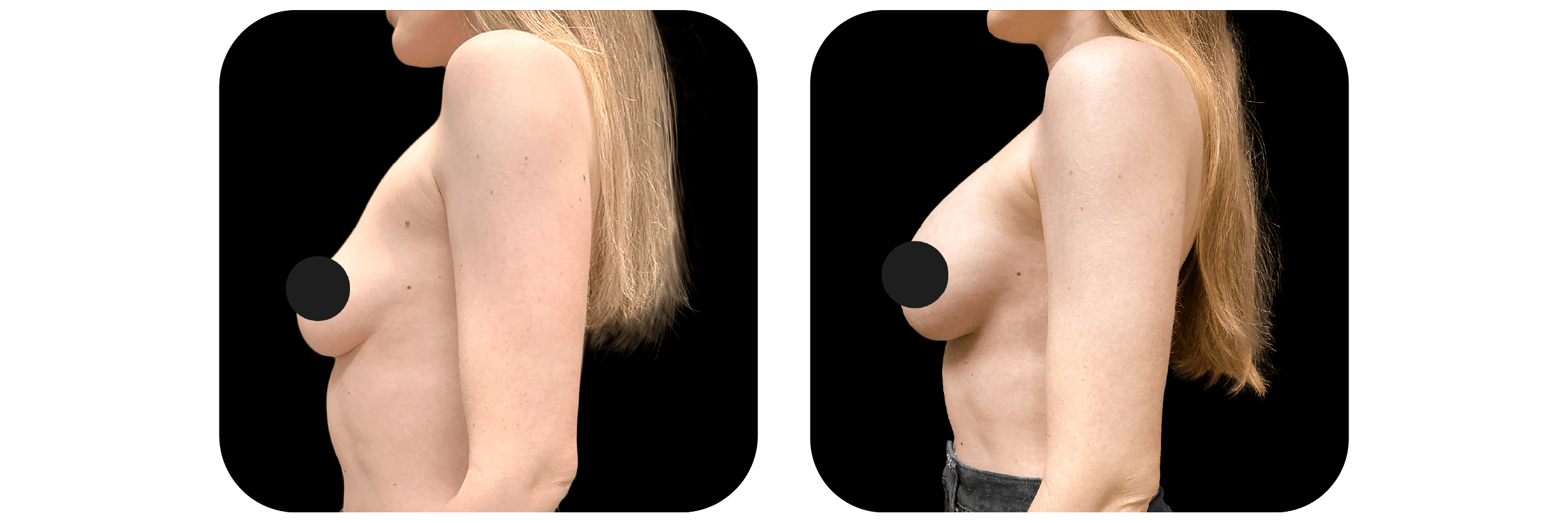 Breast Augmentation before and after - after