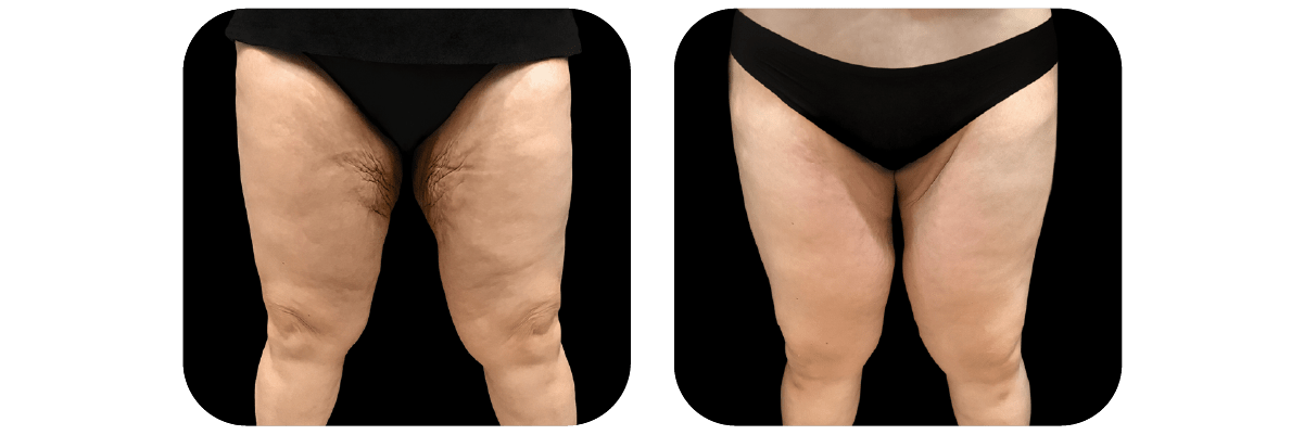 Thigh Lift by Dr. Catherine Riolo — before and after