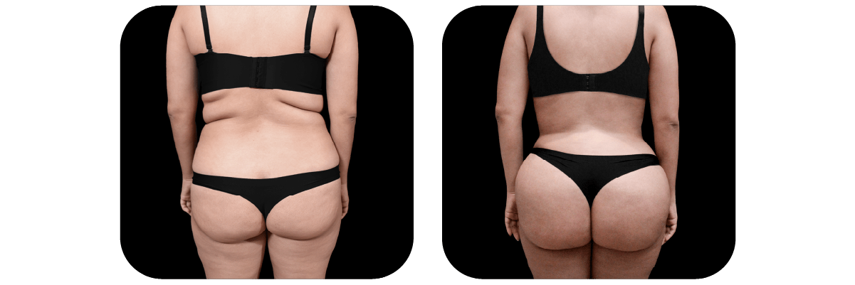 Brazilian Butt Lift / BBL by Dr. Catherine Riolo — before and after