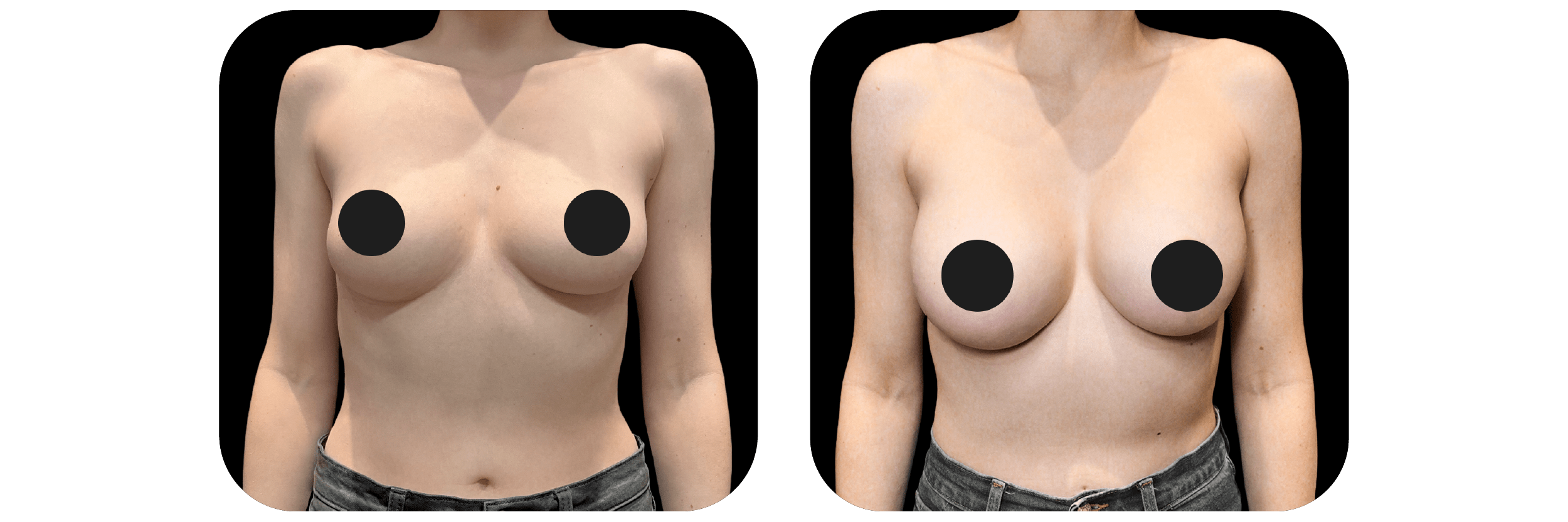 Breast Augmentation by Dr. Catherine Riolo — before and after