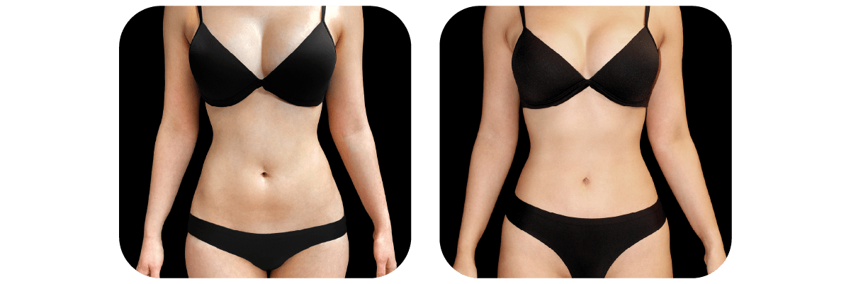 Abdominal etching by Dr. Catherine Riolo — before and after