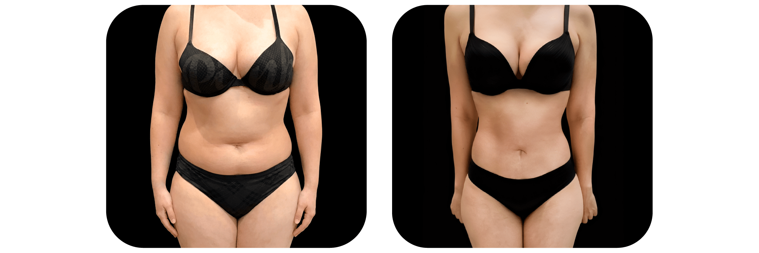 360 Liposuction by Dr. Catherine Riolo — before and after