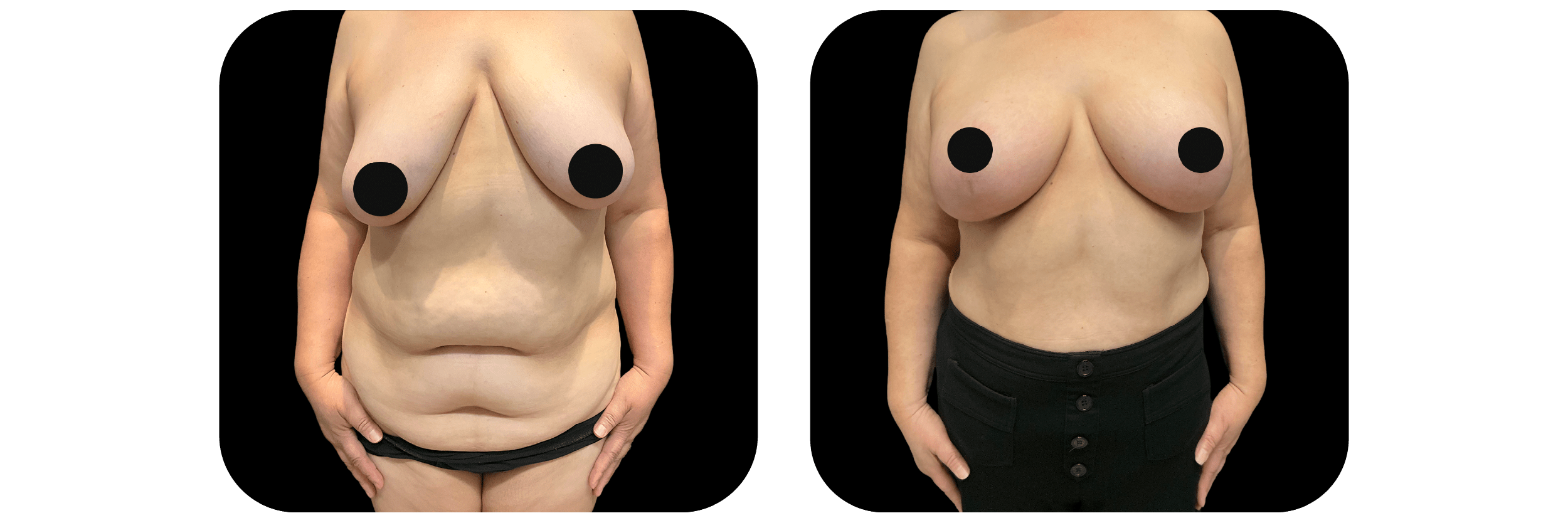 Breast Lift by Dr. Catherine Riolo — before and after