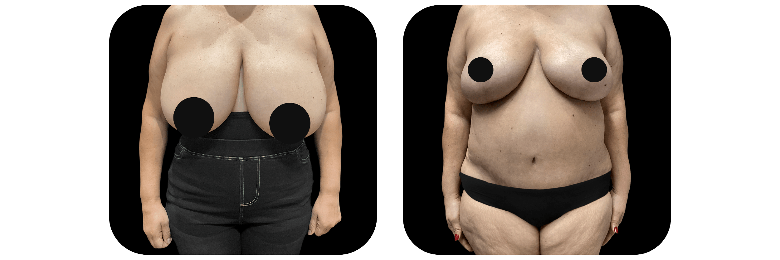Breast Reduction by Dr. Catherine Riolo — before and after