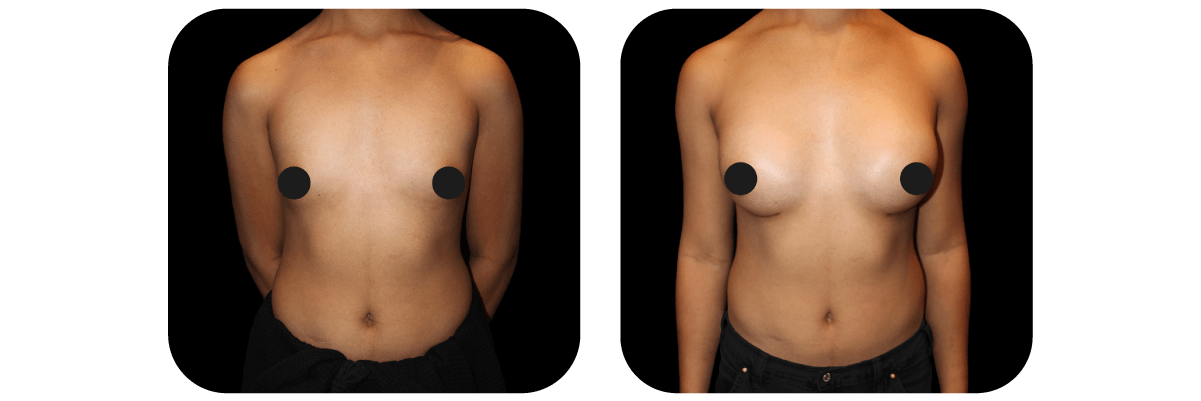 Gender Affirmation by Dr. Catherine Riolo — before and after