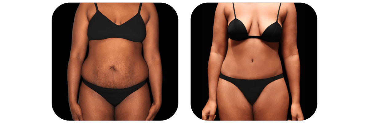 Tummy Tuck by Dr. Catherine Riolo — before and after