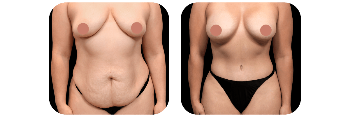 Mommy Makeover by Dr. Catherine Riolo — before and after