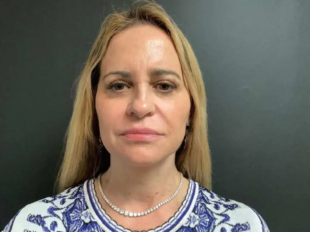 Facelift before and after - after