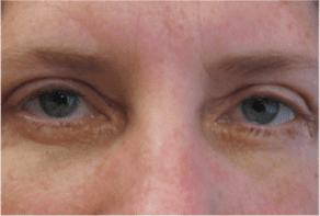 Blepharoplasty before and after - after