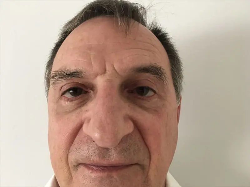 Upper and Lower Blepharoplasty before and after - after