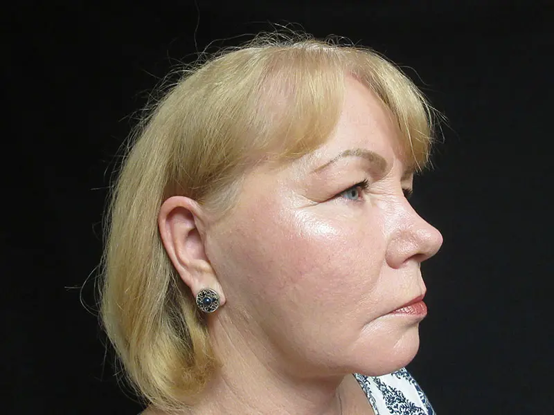 Facelift before and after - after