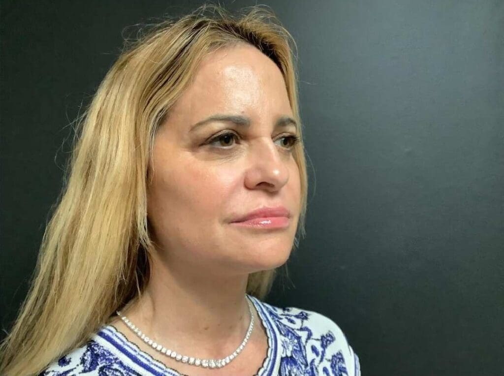 Facelift before and after - after