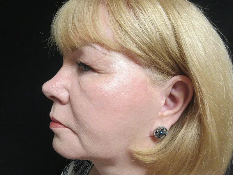 Facelift before and after - after