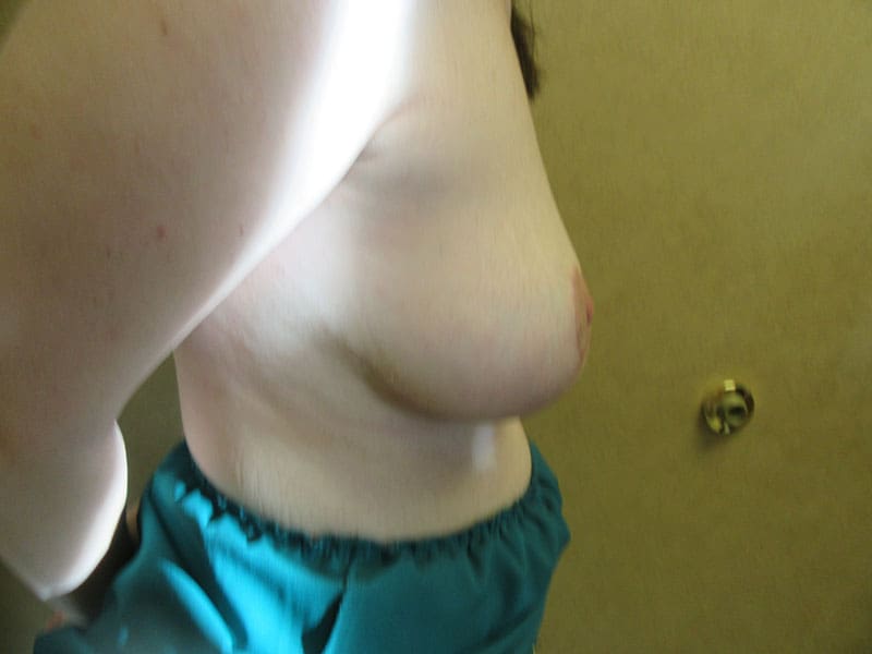 Breast Reduction before and after - after