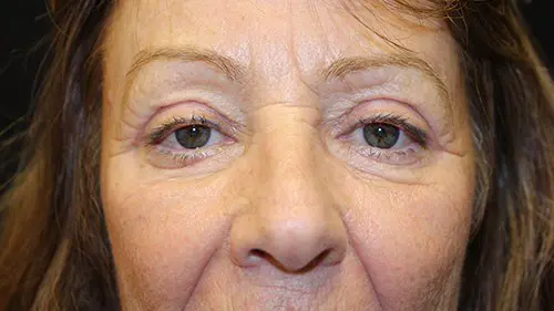 Upper and Lower Blepharoplasty before and after - after