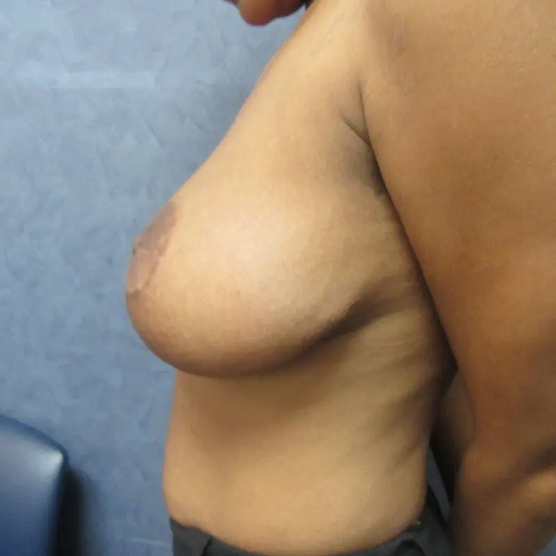 Breast Reduction before and after - after