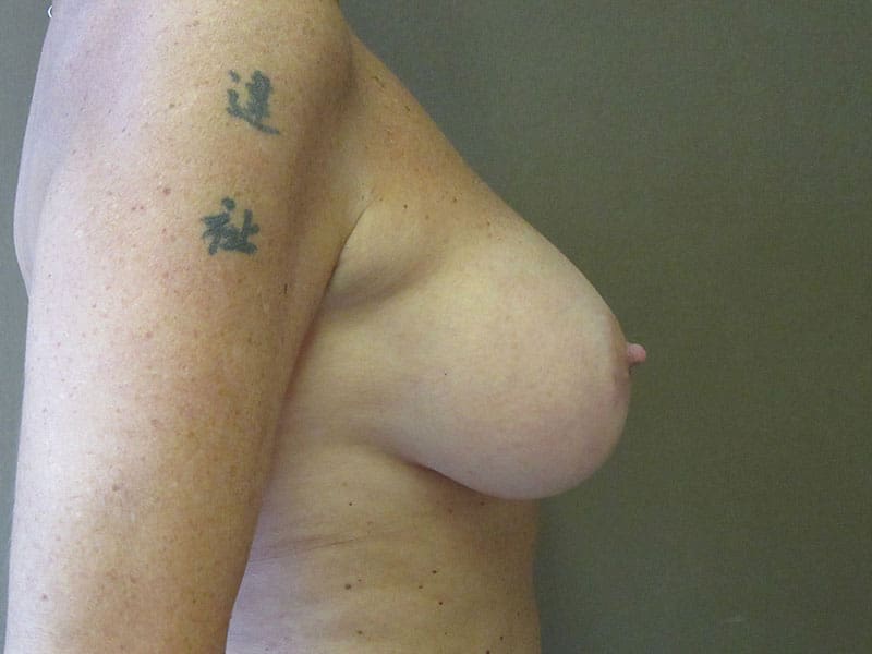 Breast Augmentation before and after - after