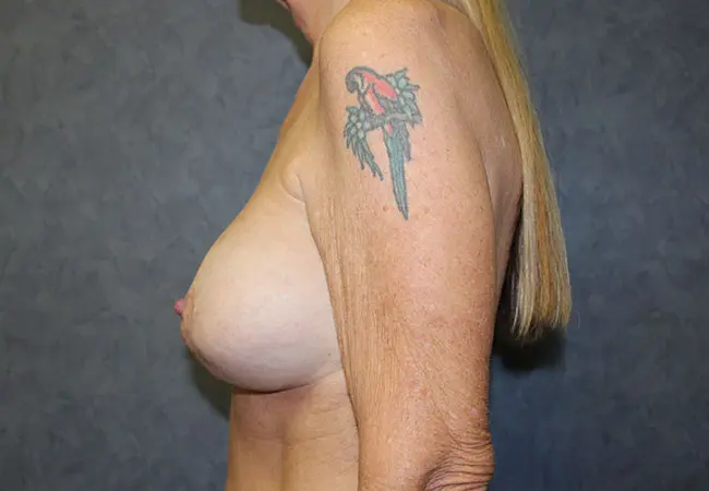 Breast Augmentation before and after - after
