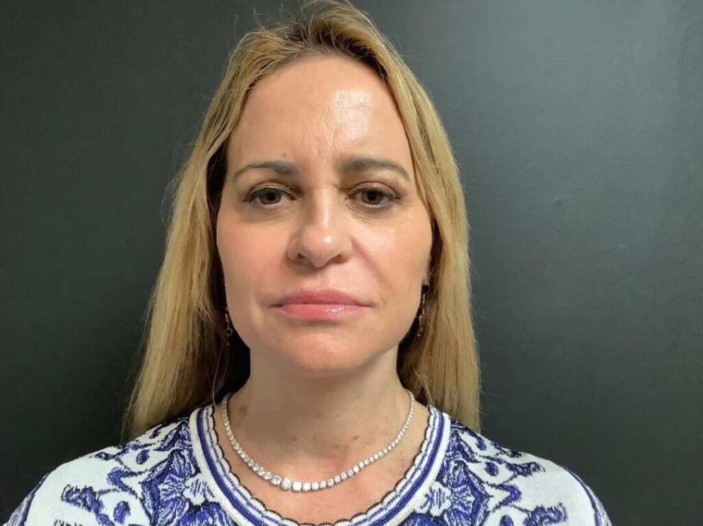 Facelift before and after - after