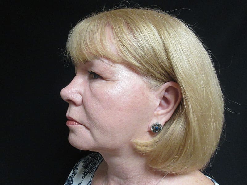 Facelift before and after - after