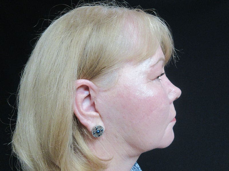 Facelift before and after - after