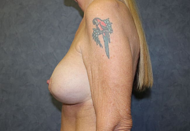 Breast Augmentation before and after - after