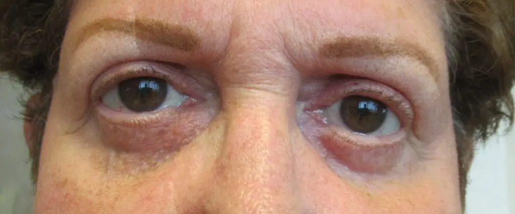 Upper and Lower Blepharoplasty before and after - after