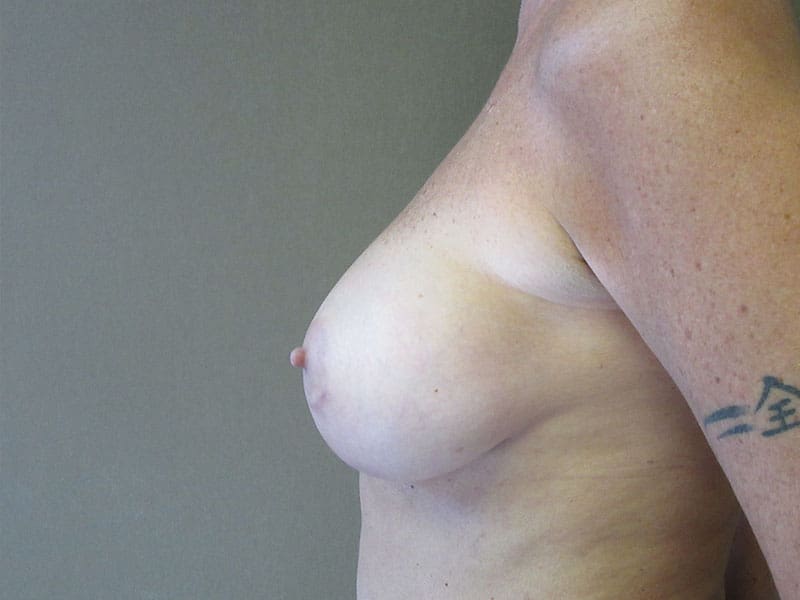 Breast Augmentation before and after - after