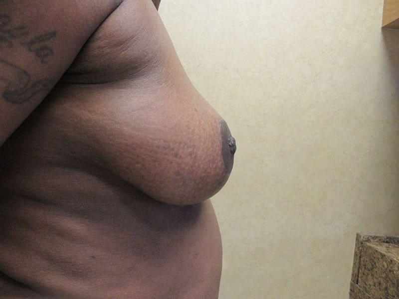 Breast Reduction before and after - after