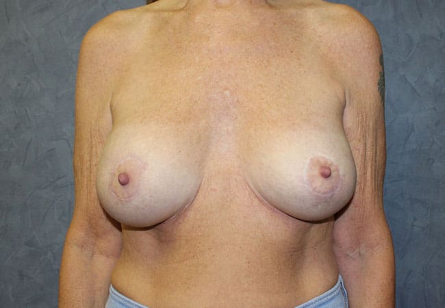 Breast Augmentation before and after - after