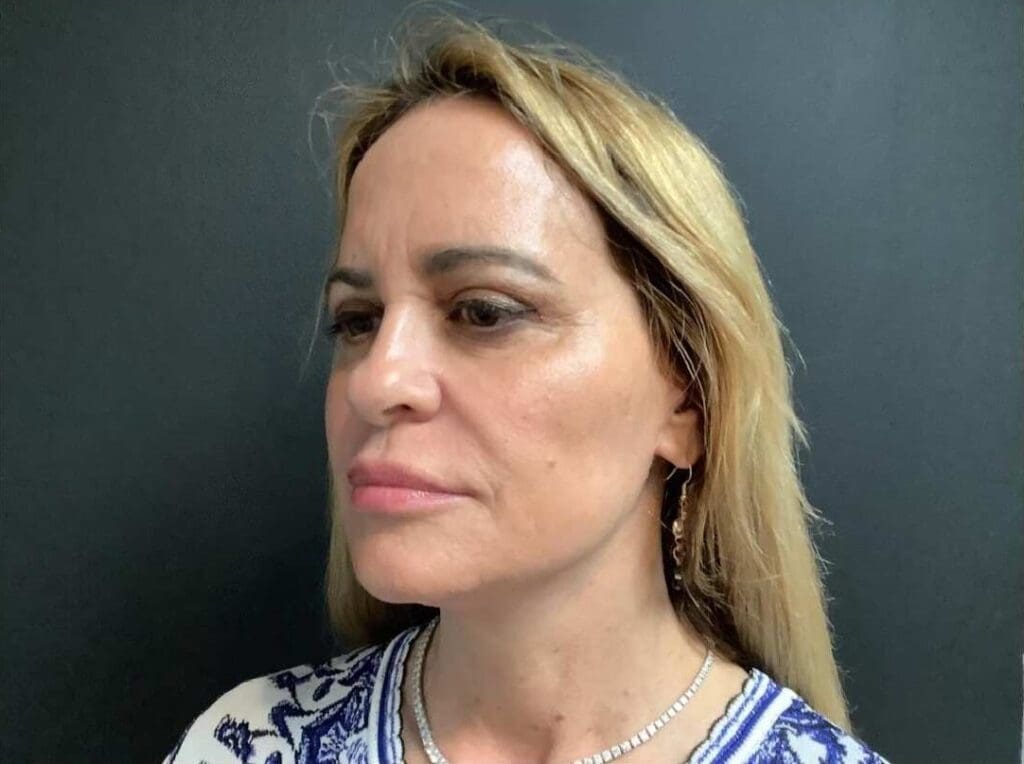 Facelift before and after - after