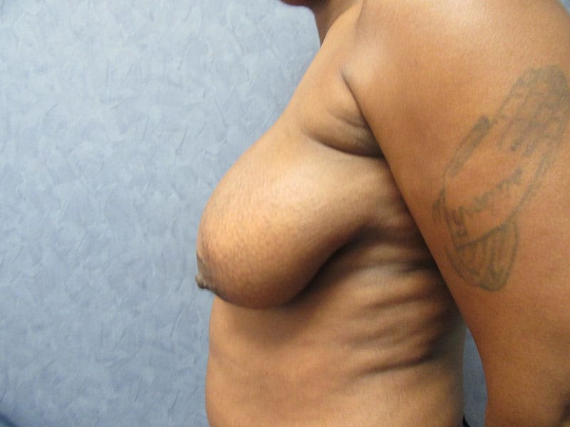 Breast Reduction before and after - before