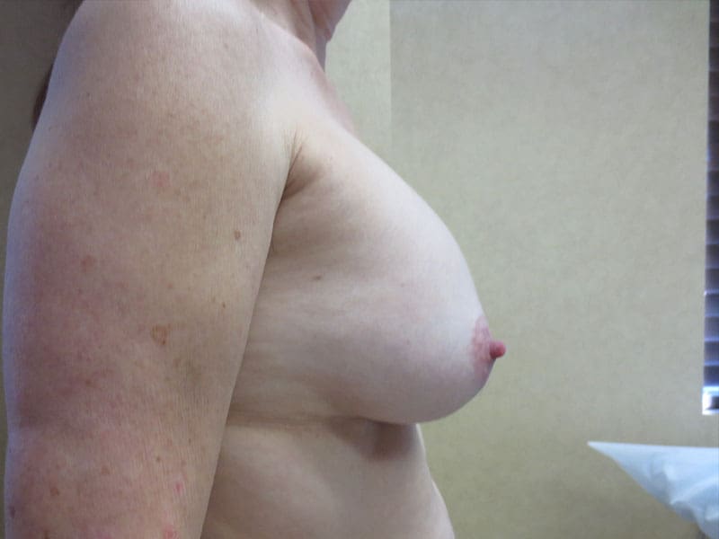 Breast Augmentation before and after - before