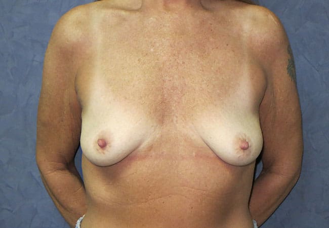 Breast Augmentation before and after - before